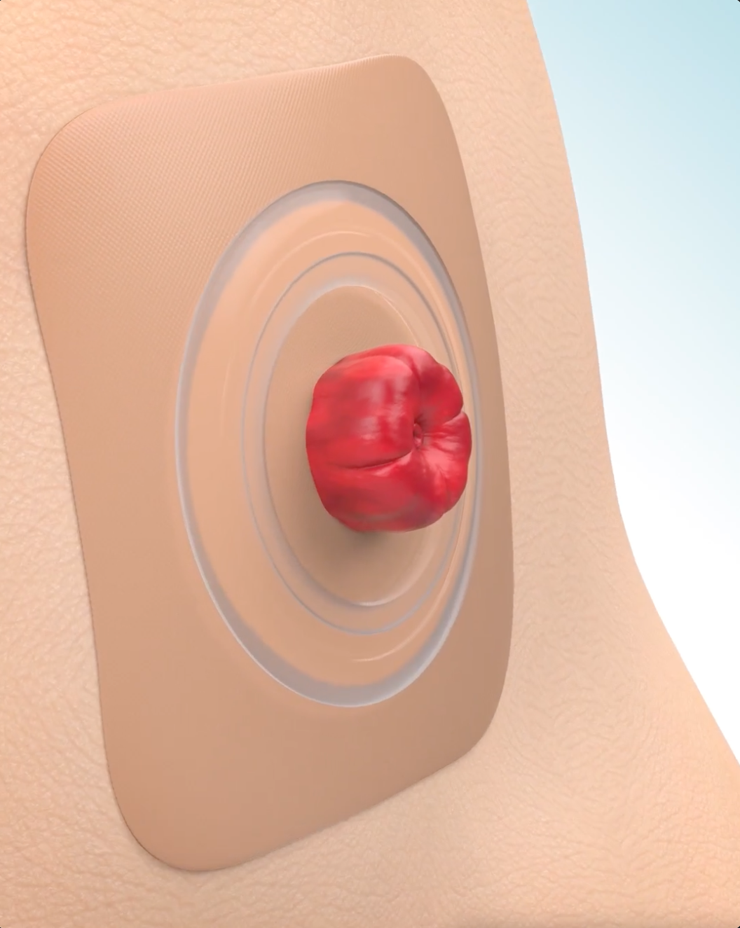 Video zur Funktionsweise von Convatec-Hydrokolloiden