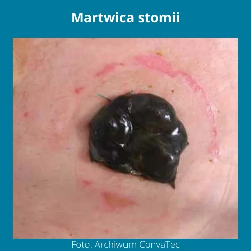 Martwica stomii - zdjęcie
